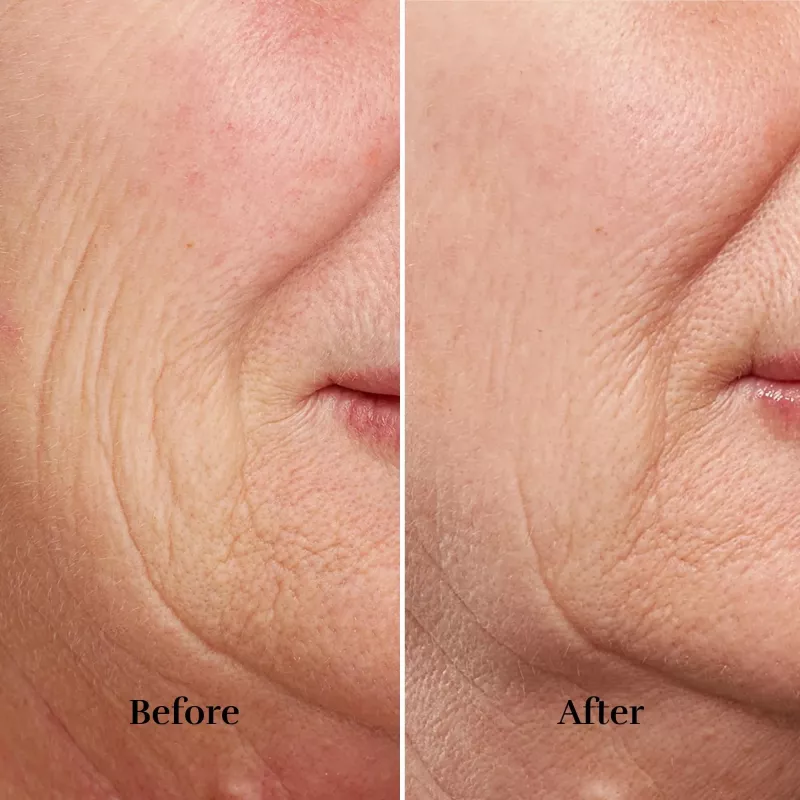 Dispositivo silk'n FaceTite FTC1PE1001 tecnología de rejuvenecimiento de la piel – tensado y contorno facial profesional