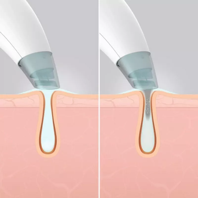 Aparato de cuidado de la piel HoMedics FAC-HY100 limpiador por hidrodermoabrasión transparente, blanco
